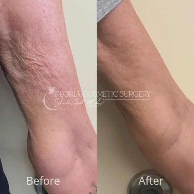 peoria-before-after-PRX Case 5b