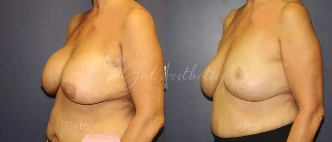 LGC 8 month_ post-op pre-op 4