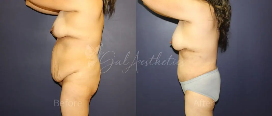 GR 5 month_ post-op pre-op 3