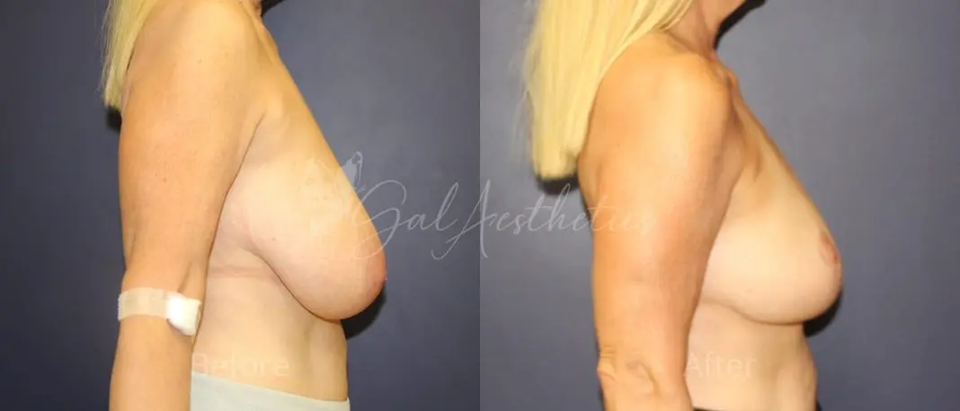 MA 1 year_ post-op pre-op 3
