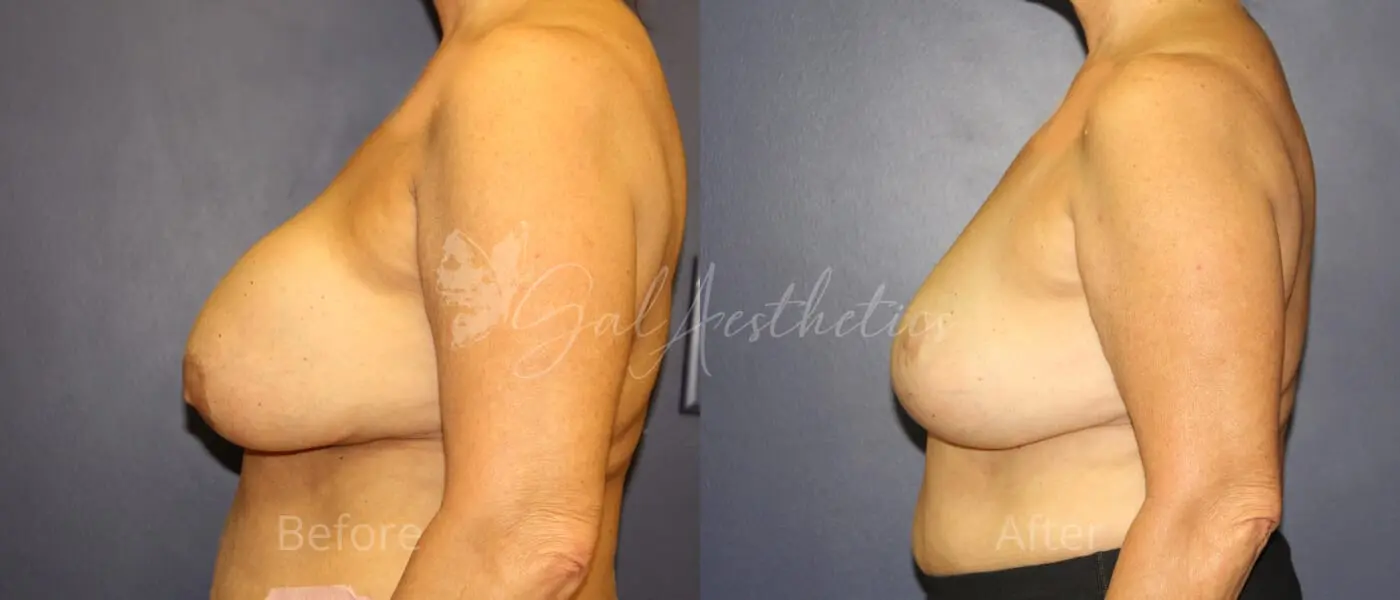 LGC 8 month_ post-op pre-op 4-1