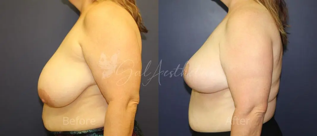 KM 3 month_ post-op pre-op 4