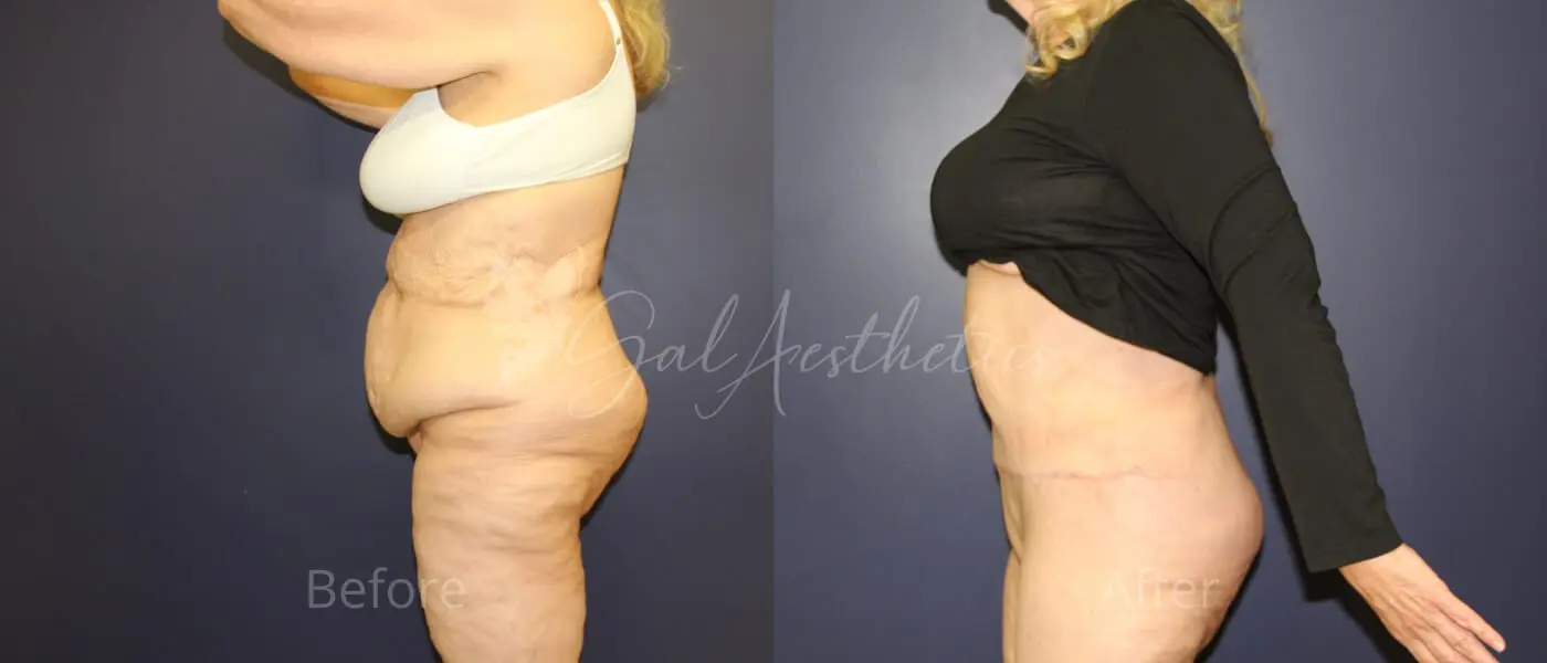 FT 3 month_ post-op pre-op 2