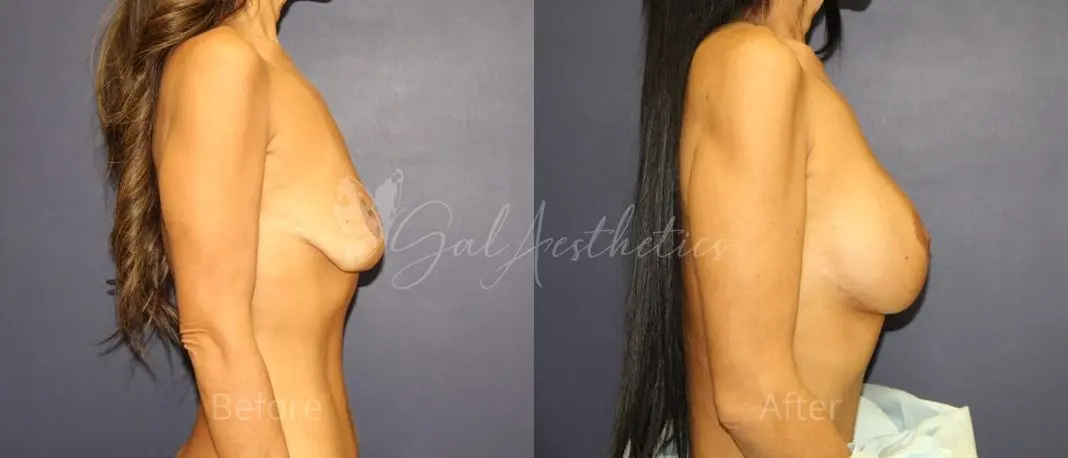 MM 4 months_ post-op pre-op 3