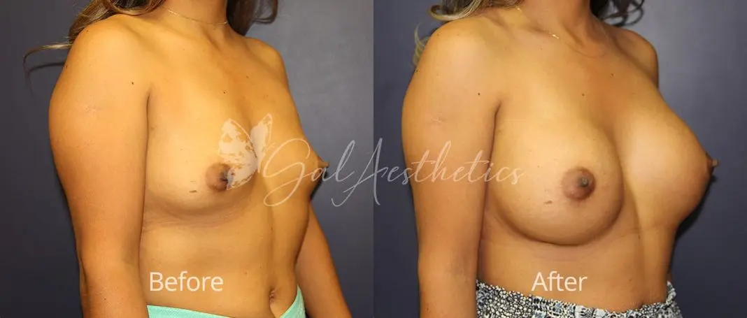 Breast Augmentation MMS 4