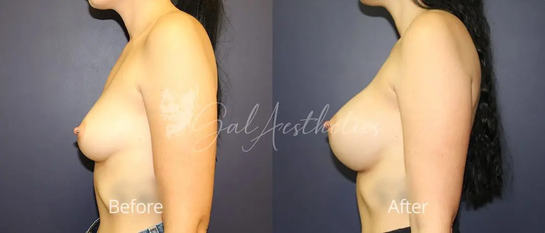 Breast Augmentation TJ 2