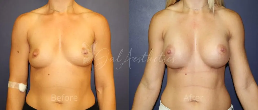 TB 3 month_ post-op pre-op 1