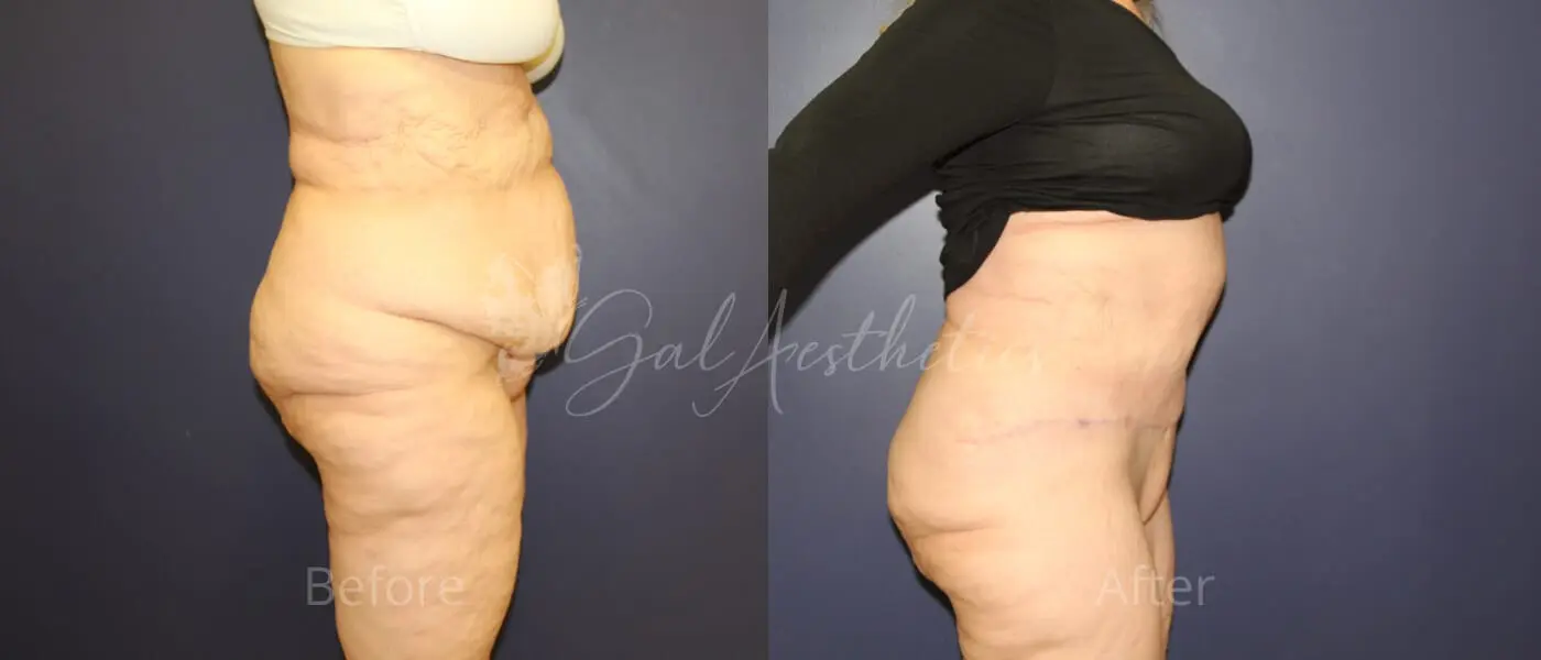 FT 3 month_ post-op pre-op 3
