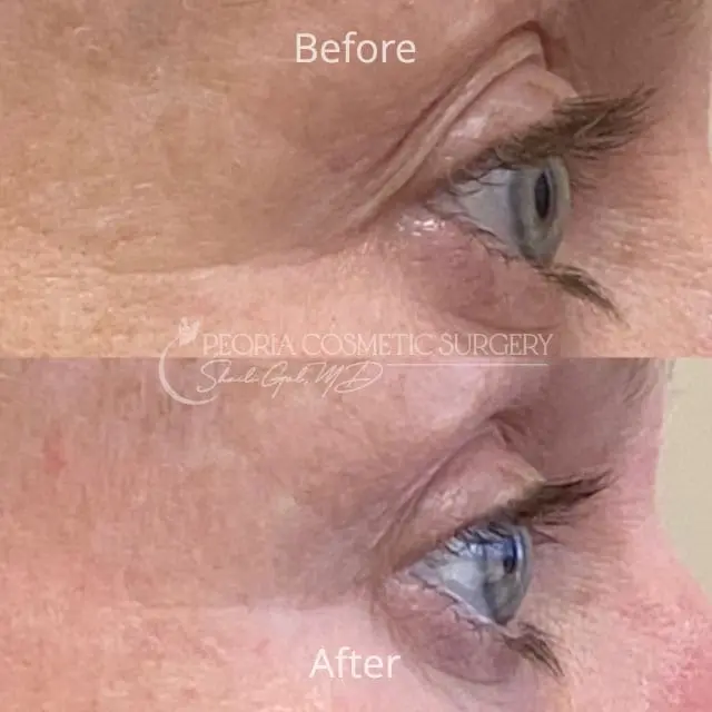 peoria-before-after-PRX Case 3