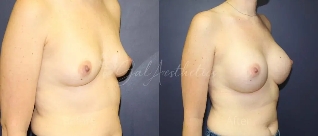 KW 3 month_ post-op pre-op 3