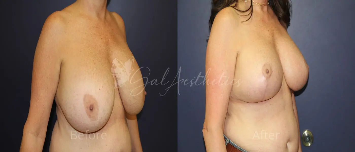 PT 3 month_ post-op pre-op 2