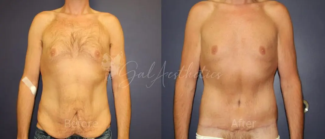 JB 3 month_ post-op pre-op 1