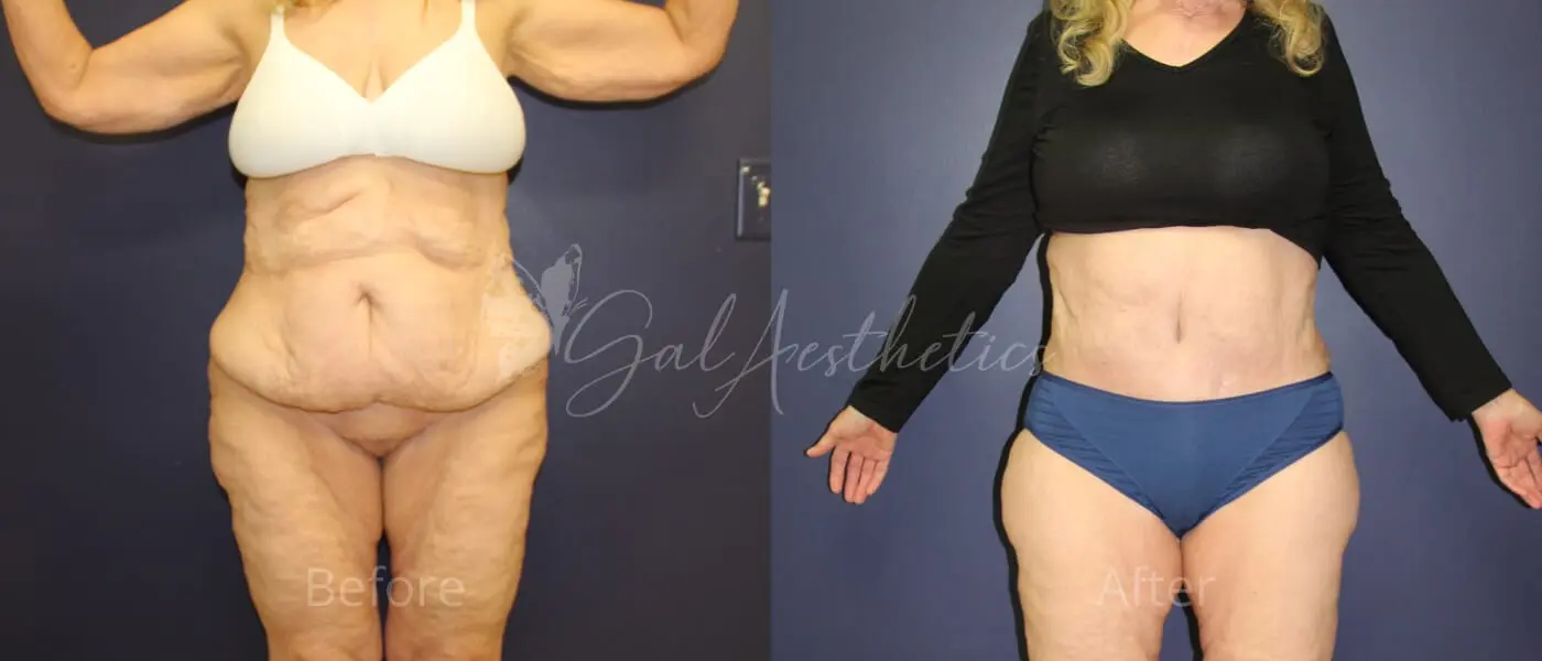 FT 3 month_ post-op pre-op 1 (1)