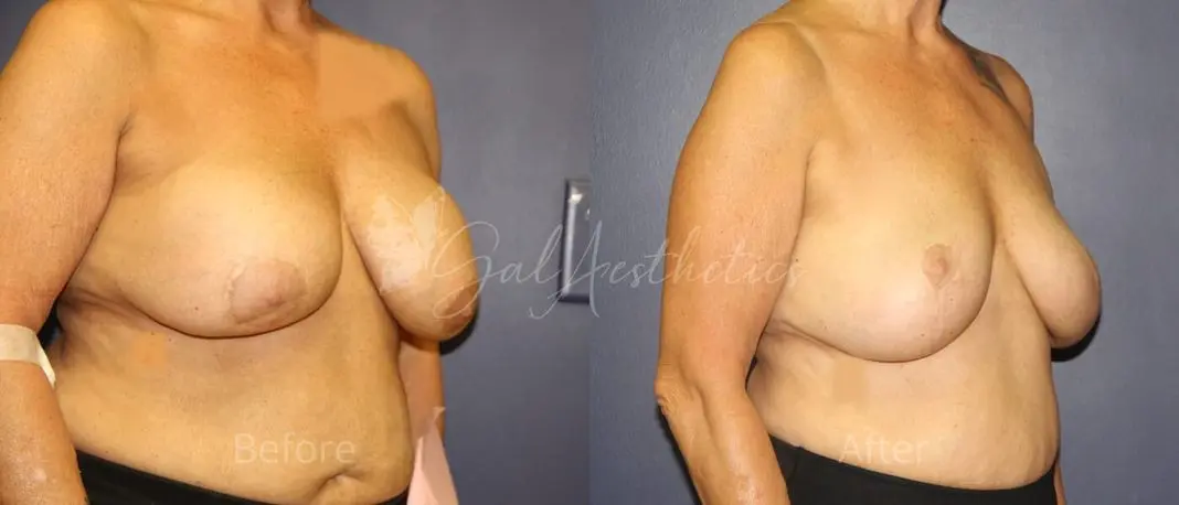 LGC 8 month_ post-op pre-op 2