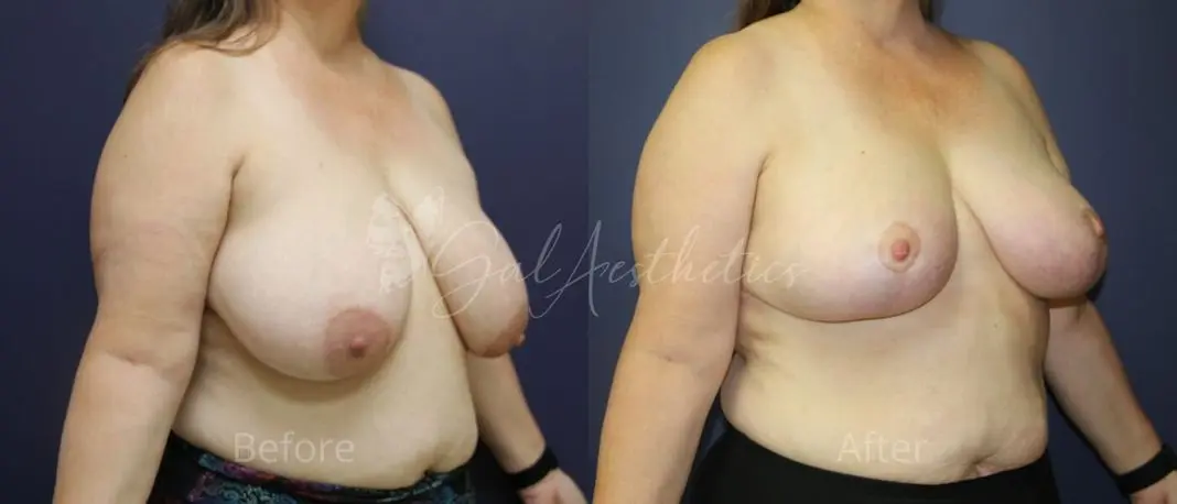 KM 3 month_ post-op pre-op 2