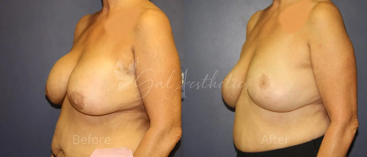 LGC 8 month_ post-op pre-op 4