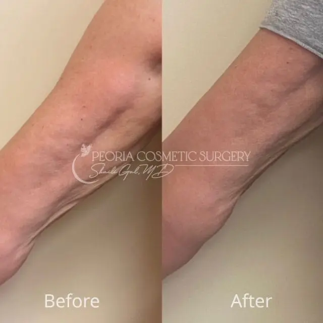 peoria-before-after-PRX Case 5a