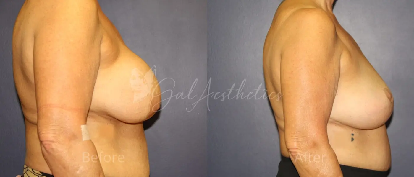 LGC 8 month_ post-op pre-op 3