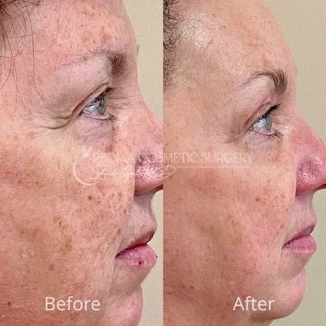 peoria-before-after-PRX Case 2b