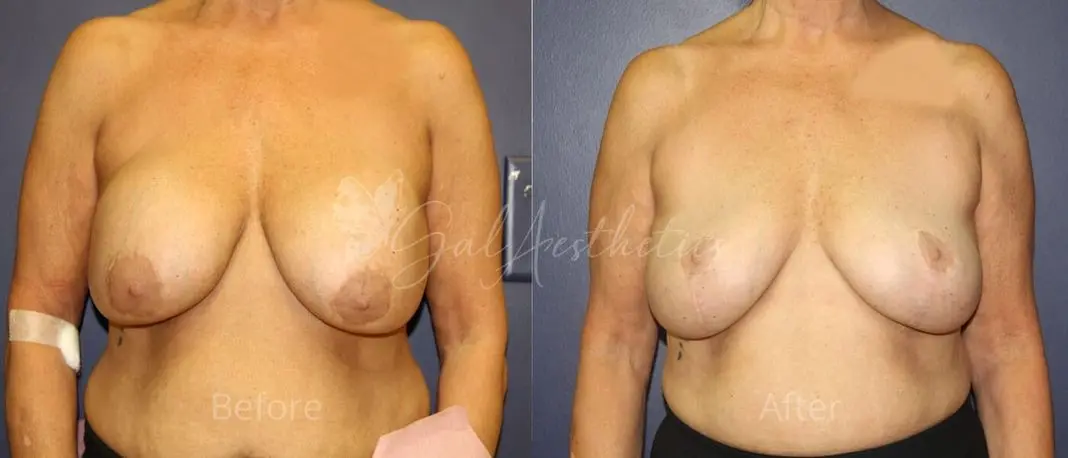 LGC 8 month_ post-op pre-op 1