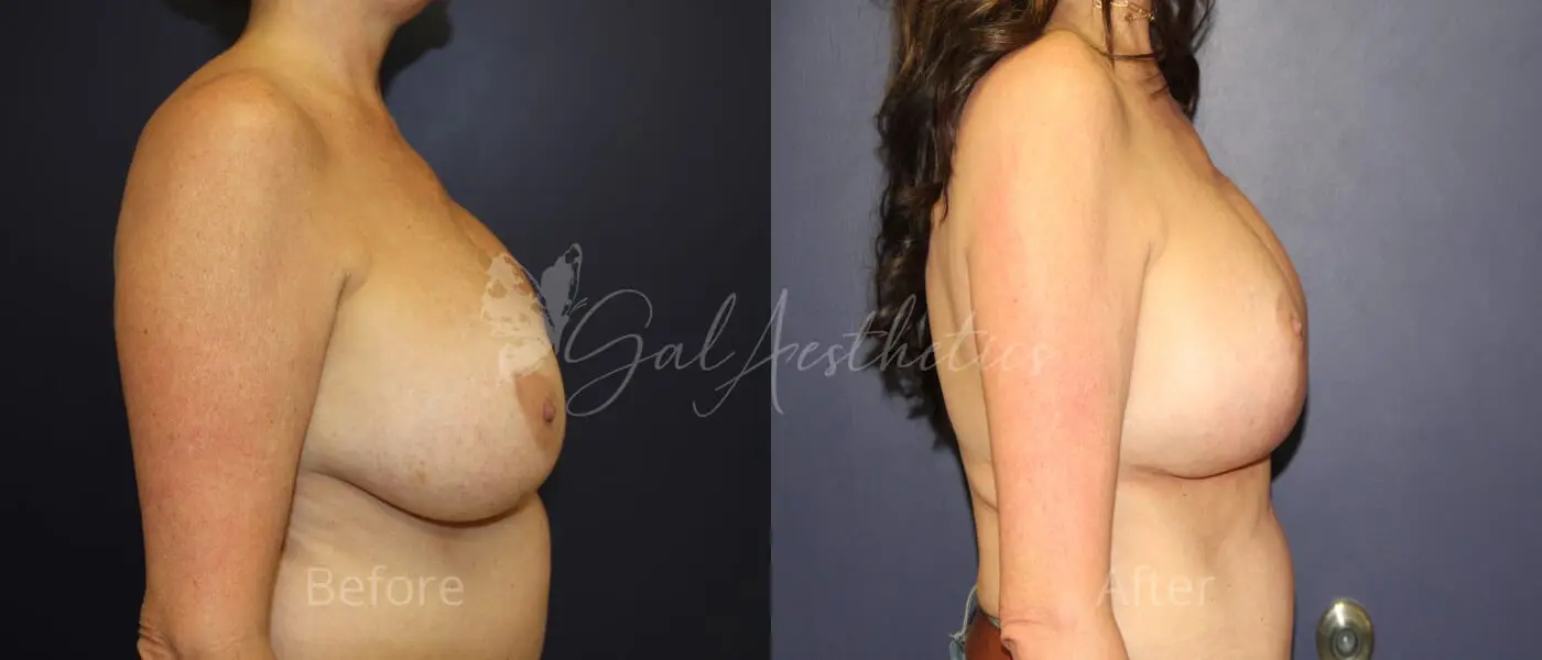 PT 3 month_ post-op pre-op 3
