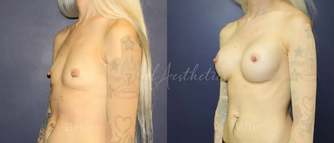 KSny 3 month_ post-op pre-op 4