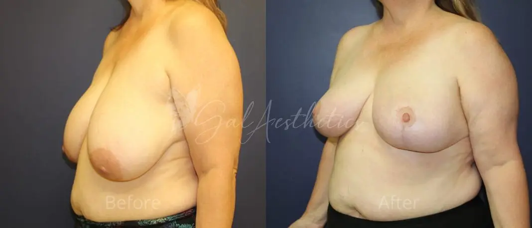 KM 3 month_ post-op pre-op 5