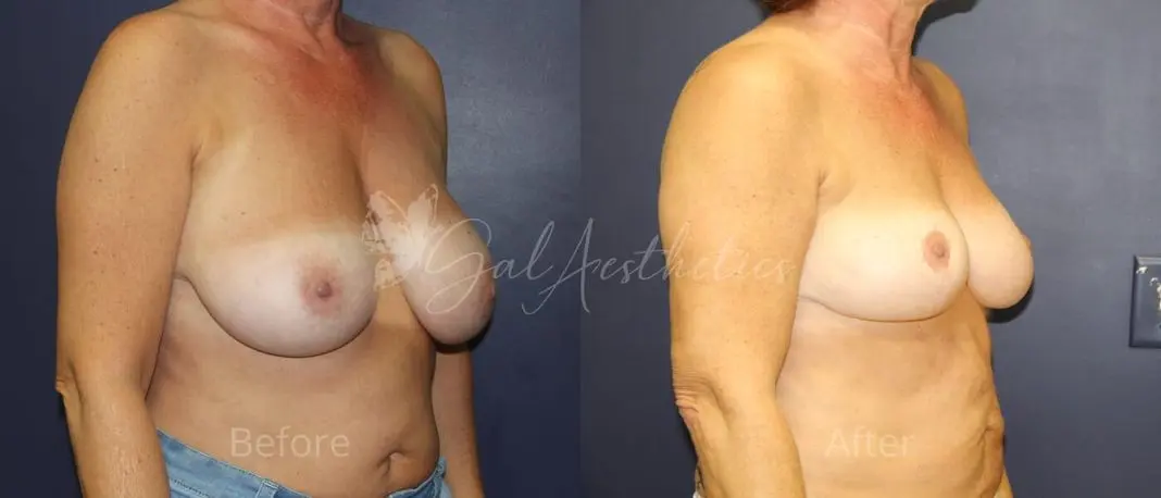 LR 1 year_ post-op pre-op 2