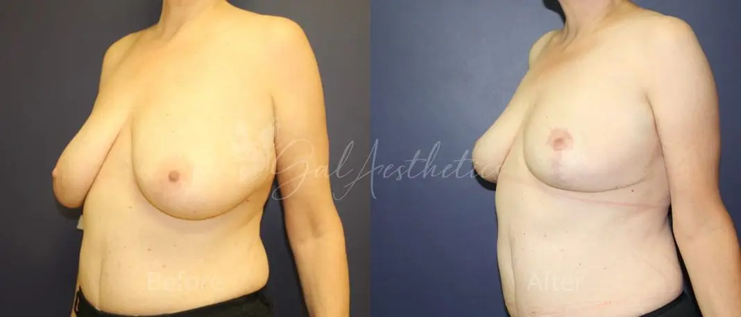 LB F month_ post-op pre-op 5