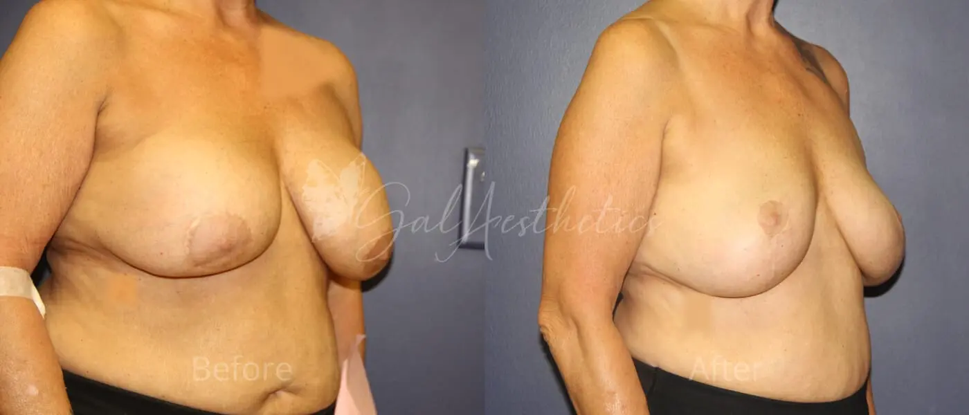 LGC 8 month_ post-op pre-op 2