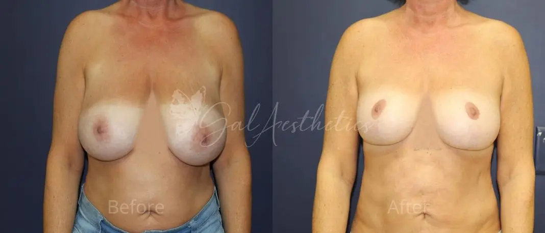 LR 1 year_ post-op pre-op 1