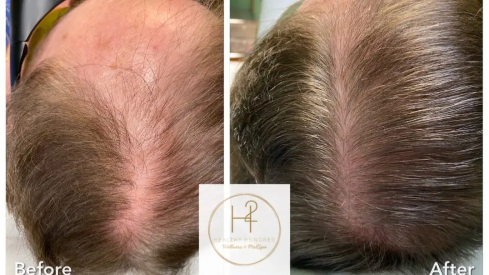 hairloss-e1644521467897-980x551