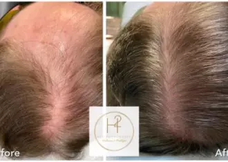 hairloss-e1644521467897-400x284-330w-1x-jpg