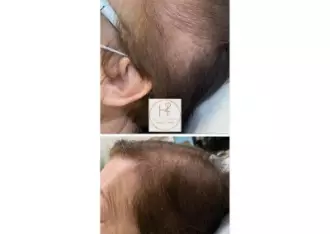 hairloss2-400x284-330w-1x-jpg