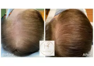 hairloss3-400x284-330w-1x-jpg