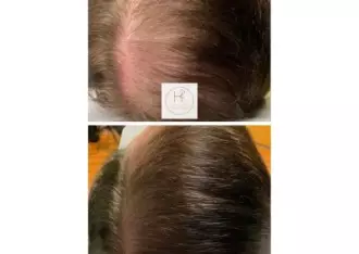 hairloss4-400x284-330w-1x-jpg
