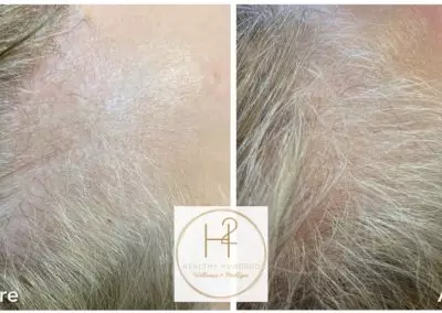 hairloss5-e1644521032476-400x284-jpg