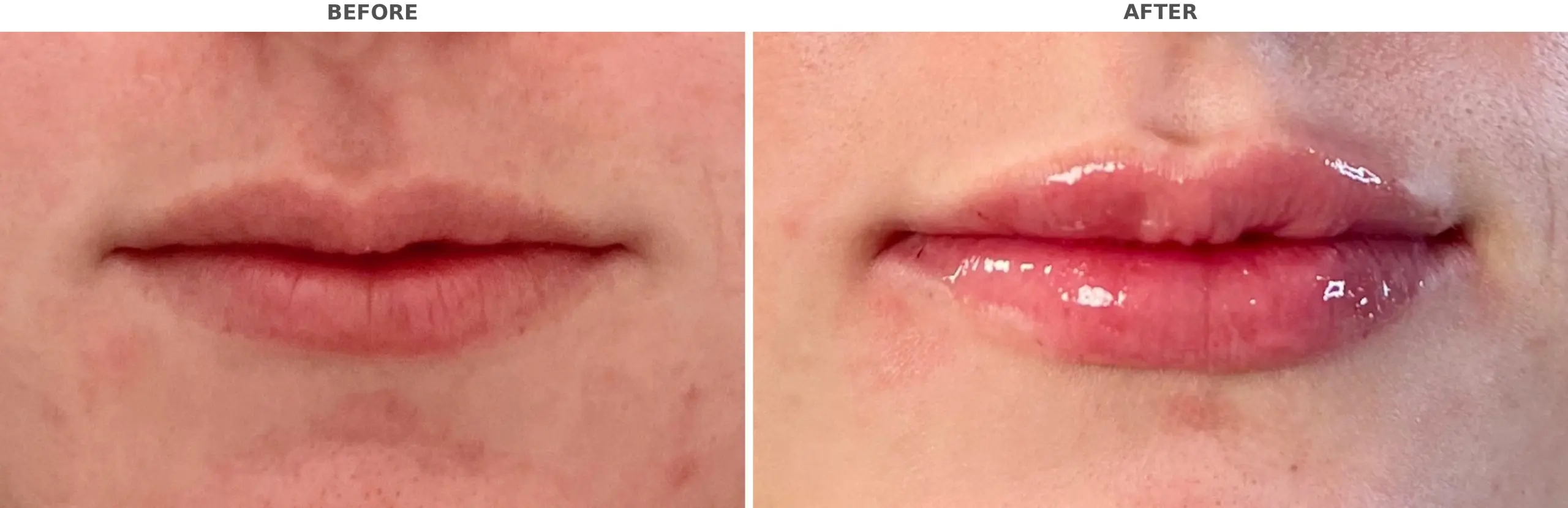 Lip Filler