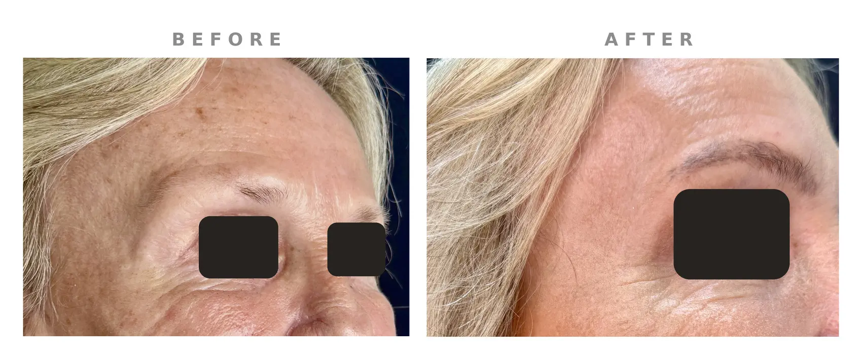 belladri-radiesse-temples-before-after-st-petersburg-fl-