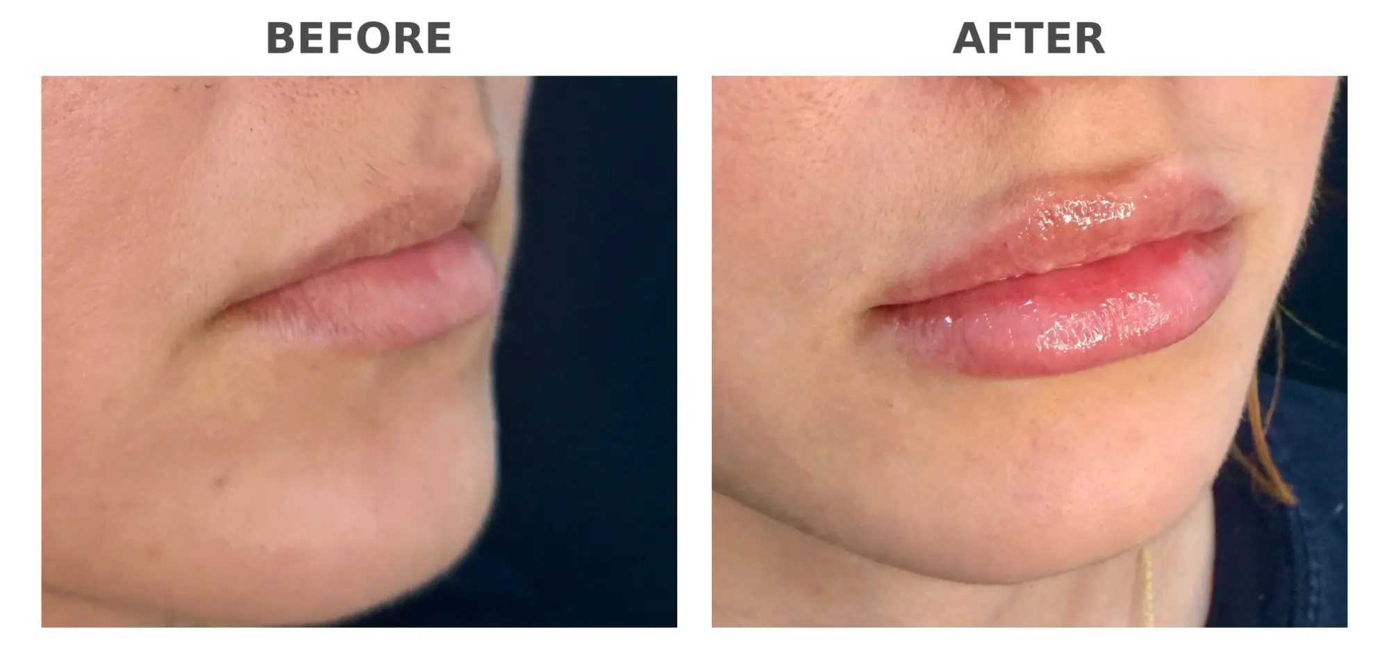 Lip Filler