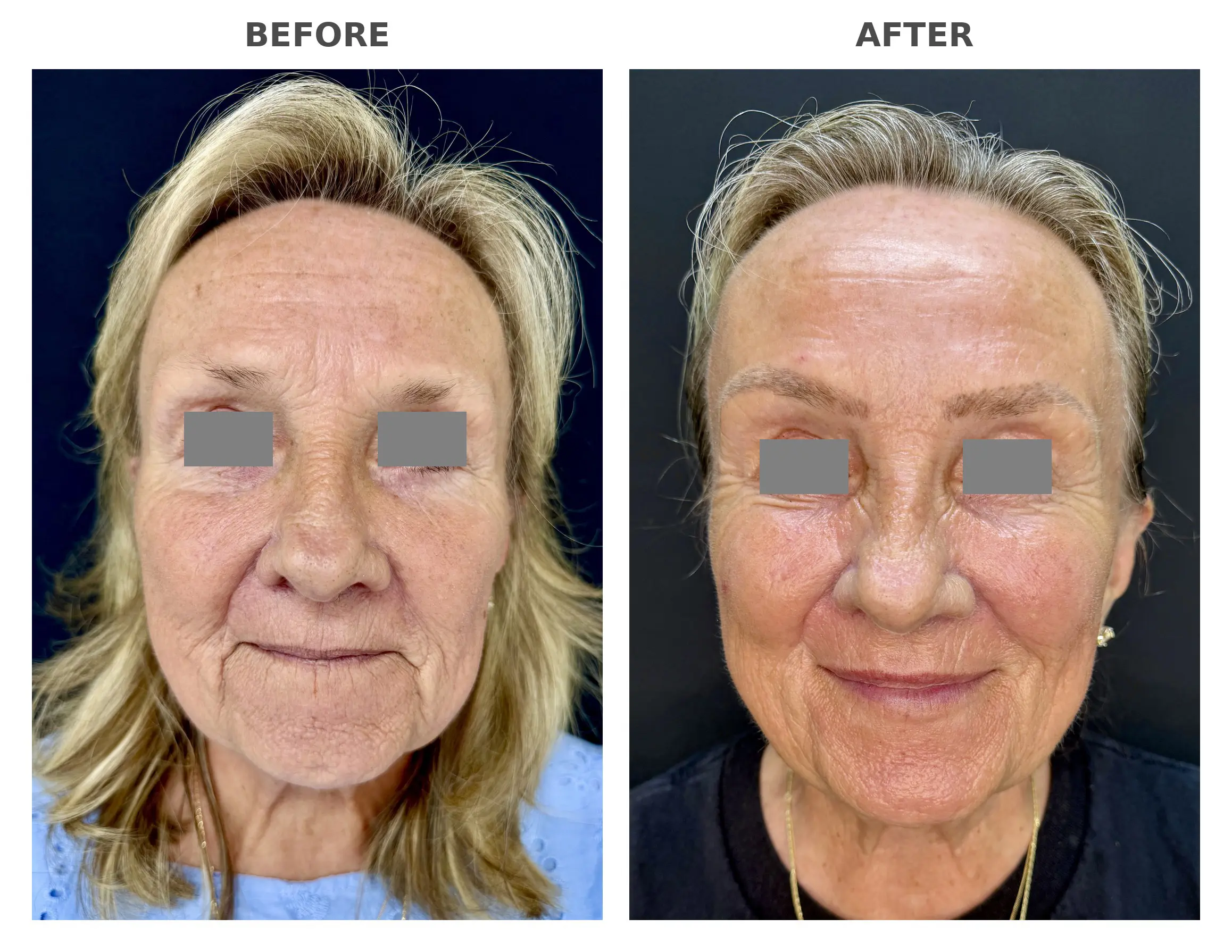 RF Microneedling