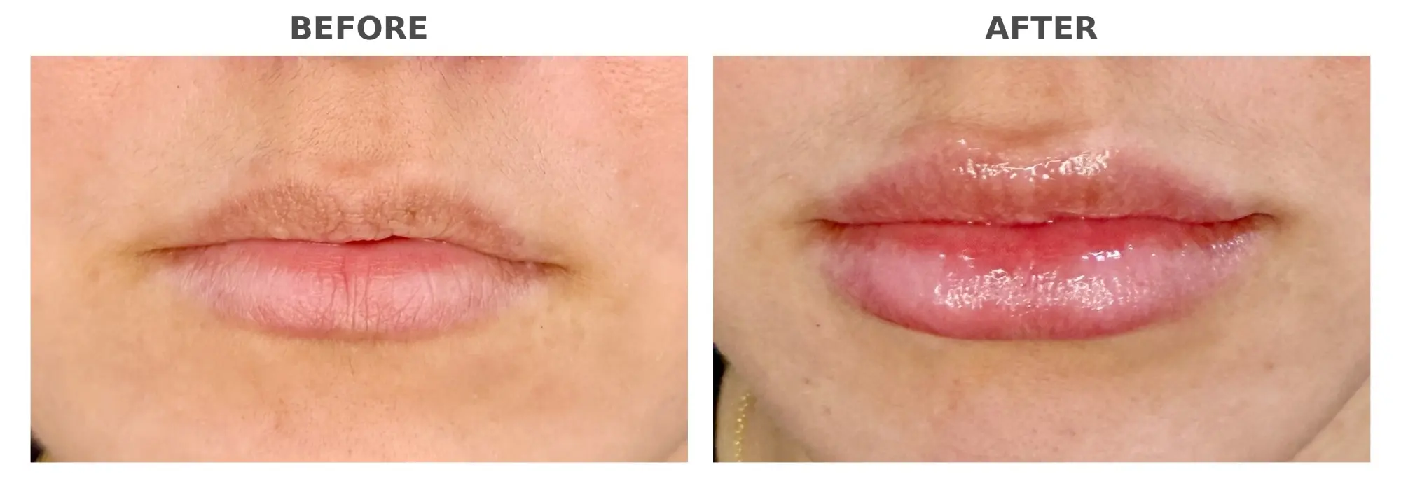Lip Filler