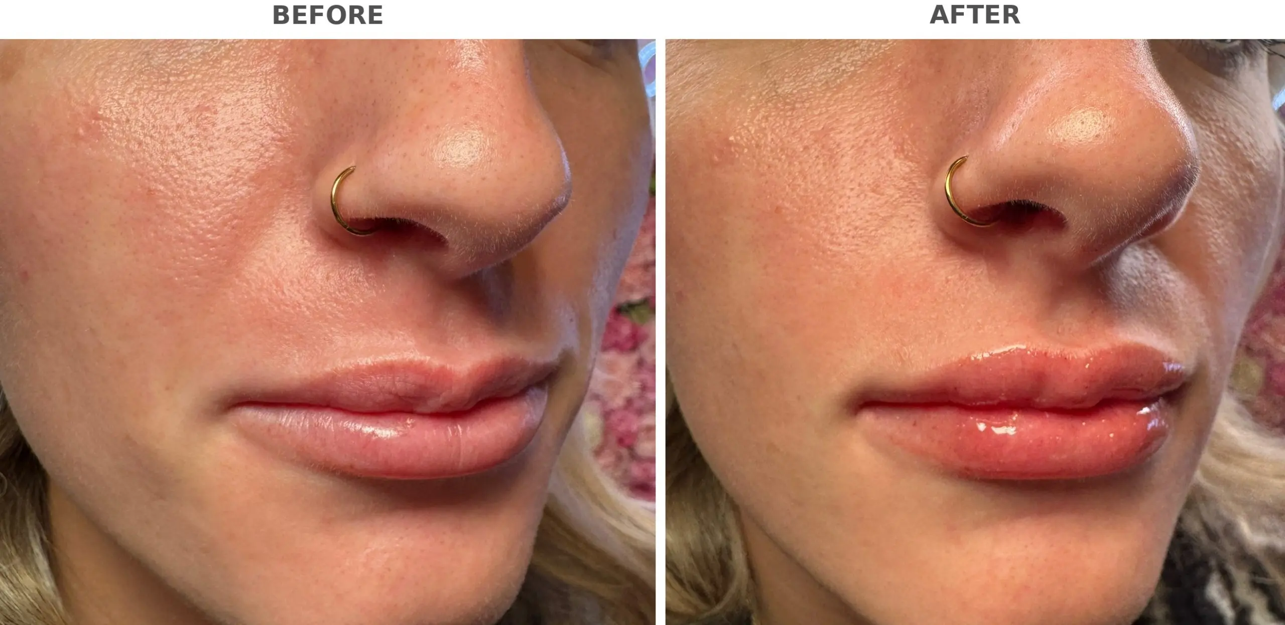 Lip Filler