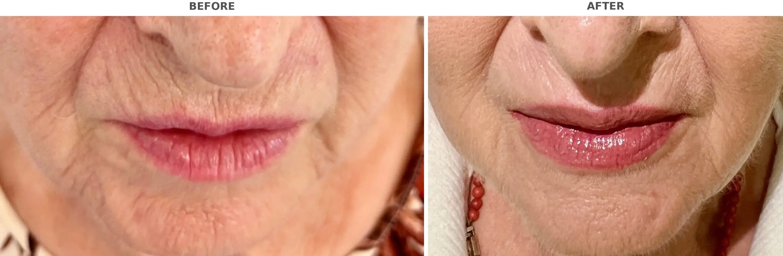 Lip Filler
