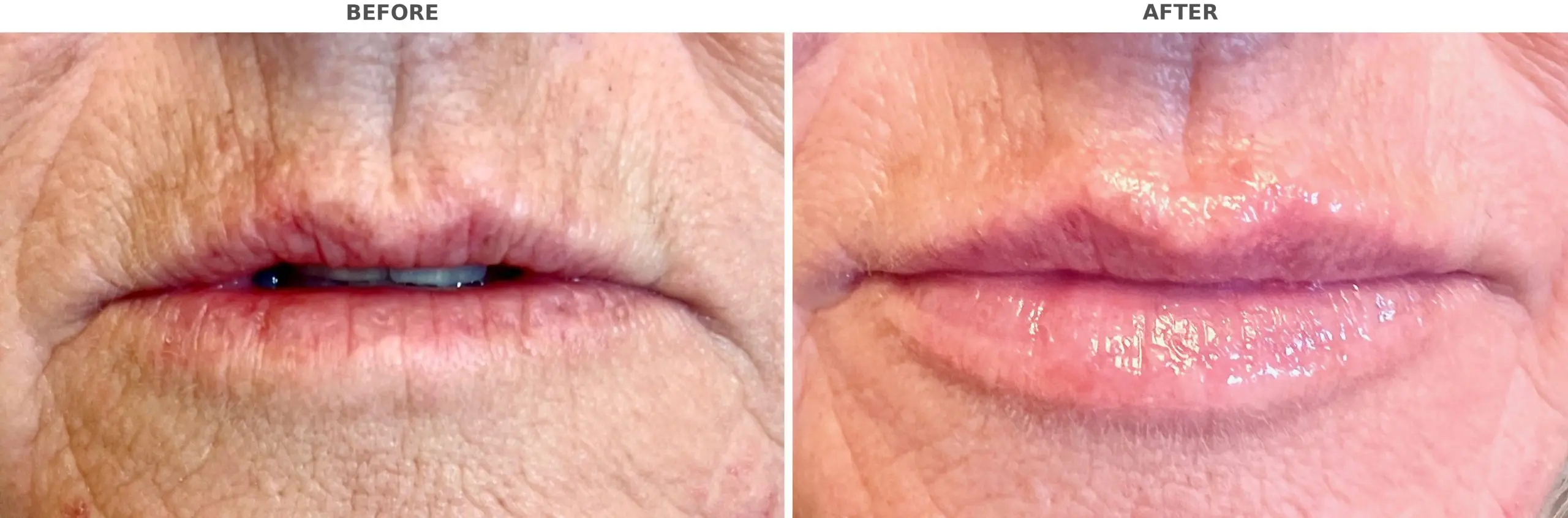 Lip Filler