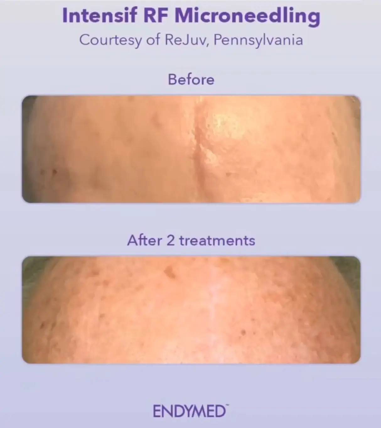 RF Microneedling