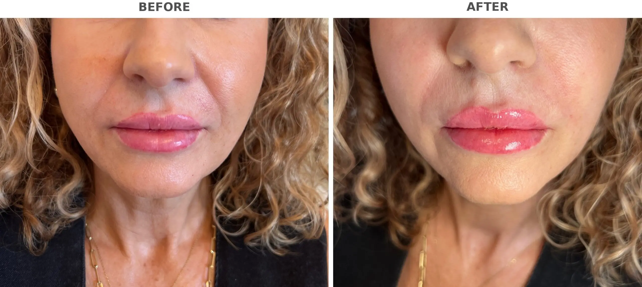 Nasolabial Fold Filler