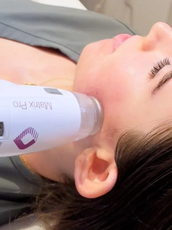 RF Microneedling