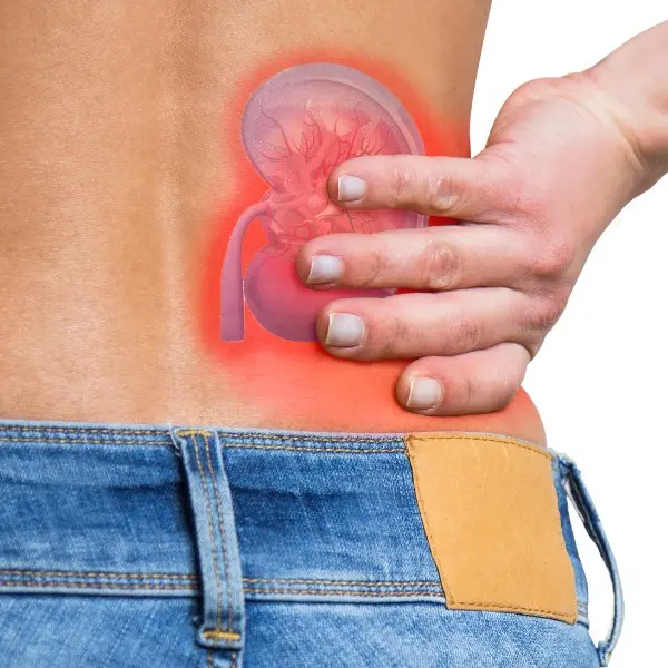 kidney-stones-2024-22