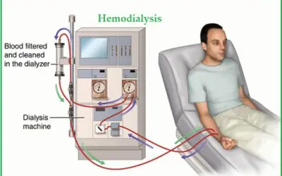 Understanding Your Dialysis Options: Hemodialysis vs. Peritoneal Dialysis